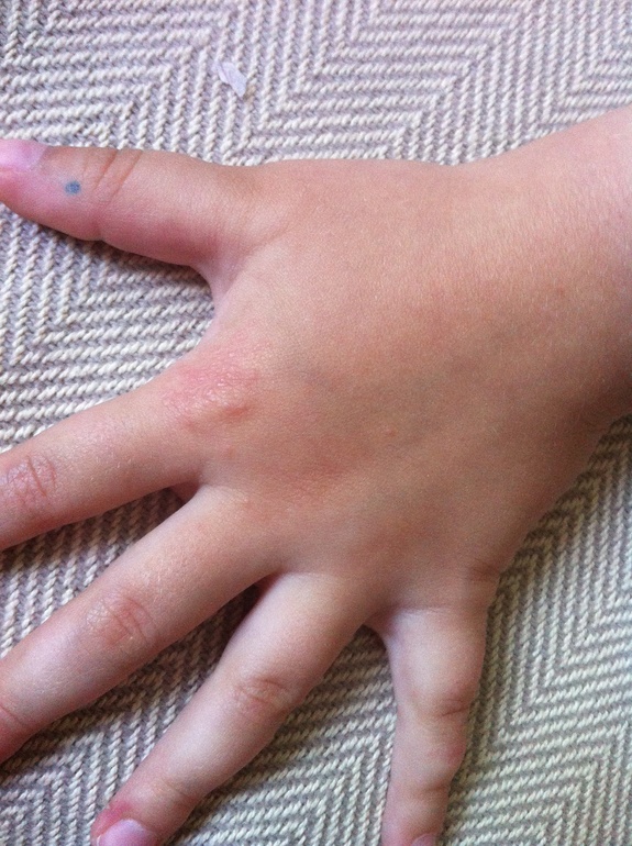 Сыпь на руках. Что это?