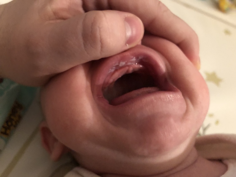 Молочница во рту у новорожденного