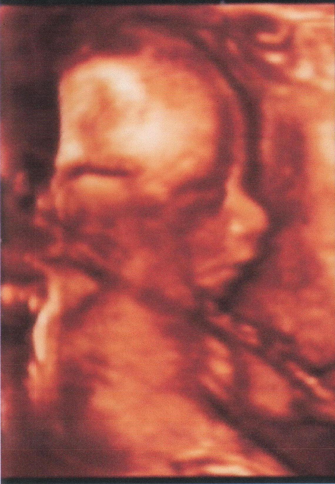 вторая беременность и роды