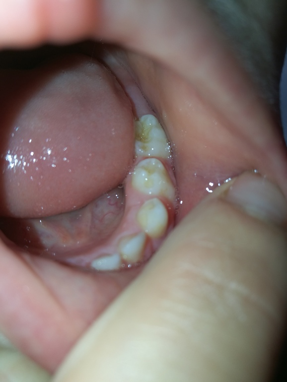 Тетрациклиновые зубы: диагностика, причины и лечение — ROOTT