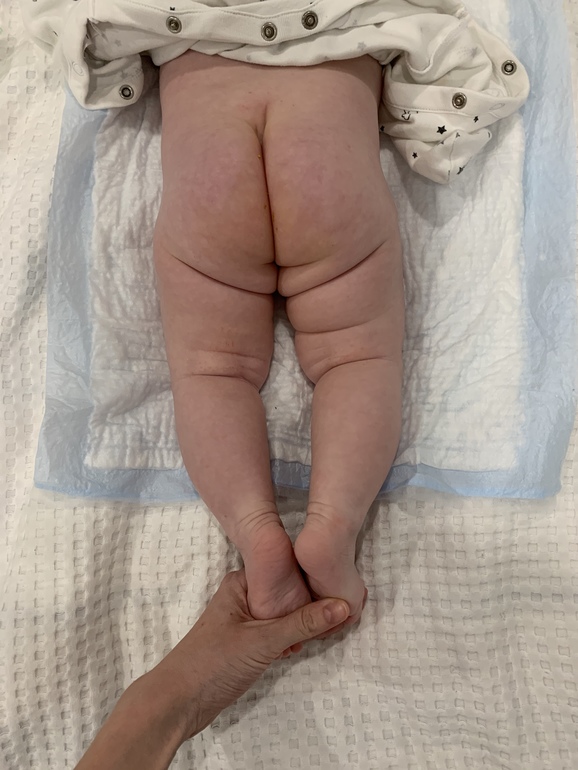 О чем расскажут ассиметричные складки на ножках у вашего малыша? | Все о здоровье | Дзен