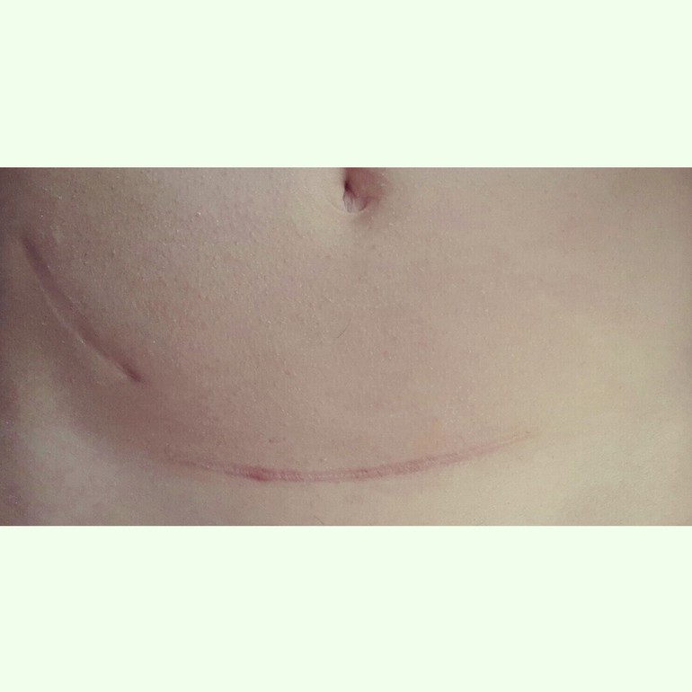 Шов после КС