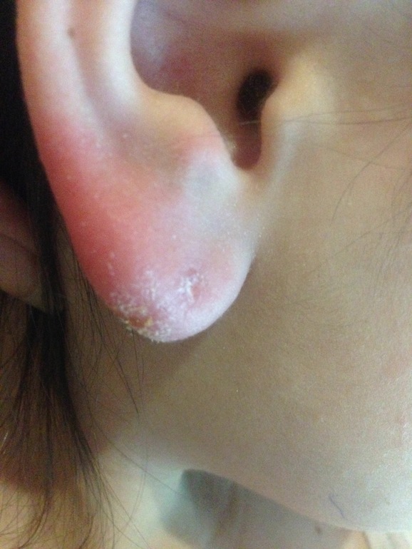 Обморожение мочки уха. Что сделать? — 15 ответов | форум Babyblog