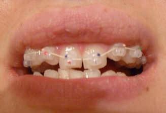 Итог моего ношения брекетов