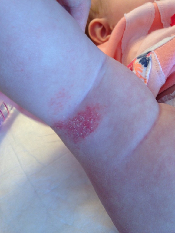 Сыпь с обратной стороны колена