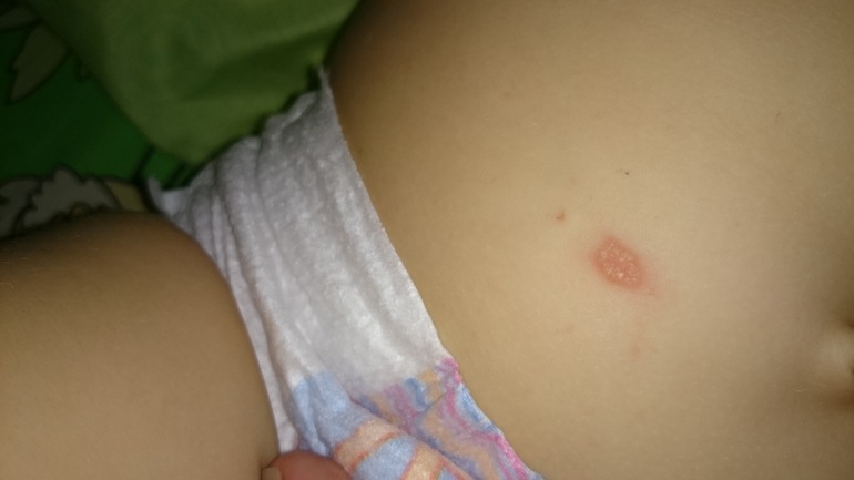 прыщик или аллергия на животике