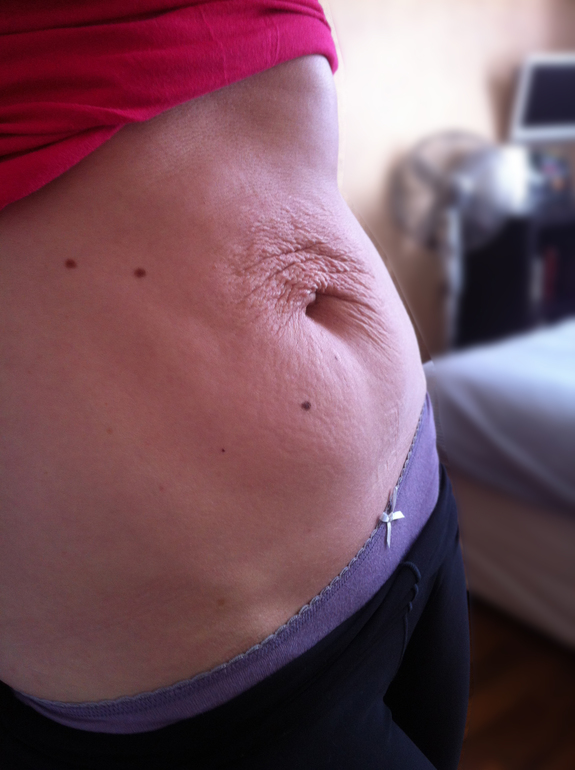 Начинаю новый этап борьбы с дряблой кожей. Ноноперфорация.