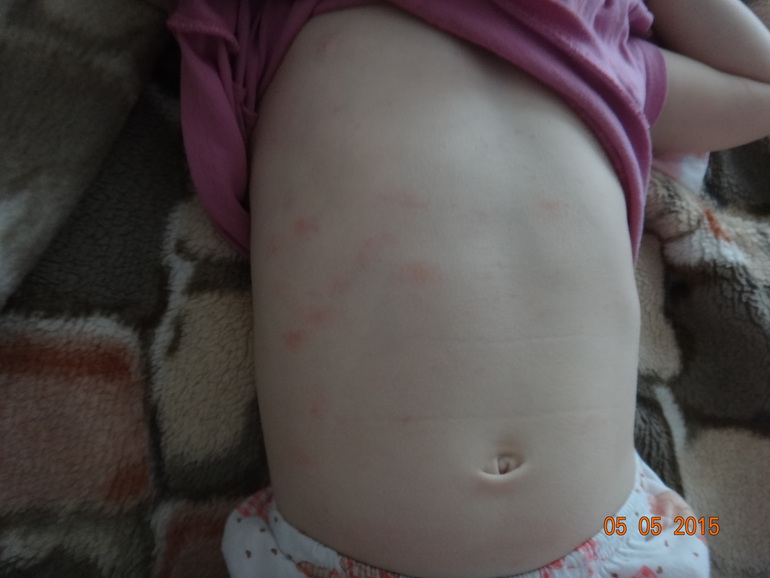 Аллергия от антибиотика флемоксин солютаб thumbnail