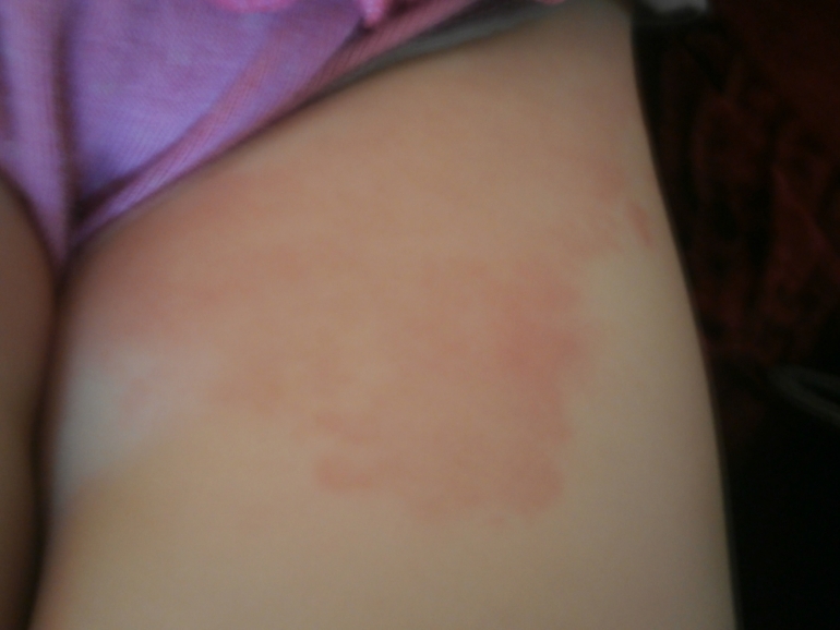 Ночью было нормально а утром вот такие большие пятна