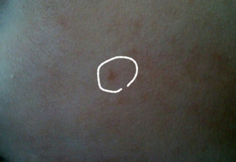 гемангиома или невус?