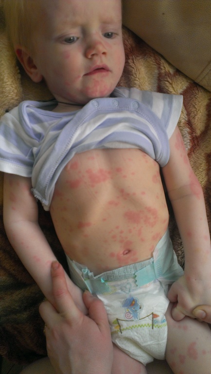 Девочки помогите!!!! Обсыпало всего.