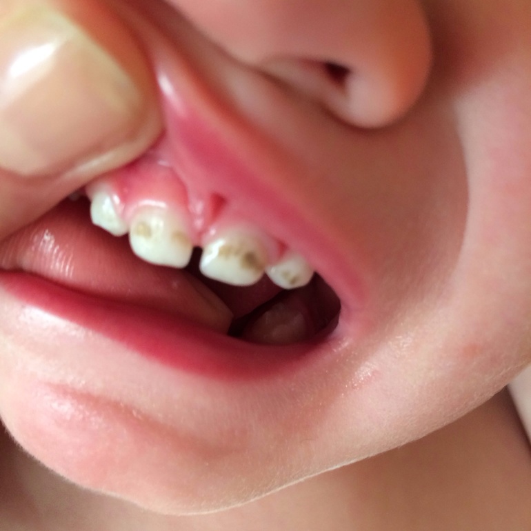 Потемнения на зубках