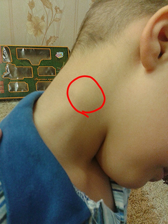 Лимфоузел(((