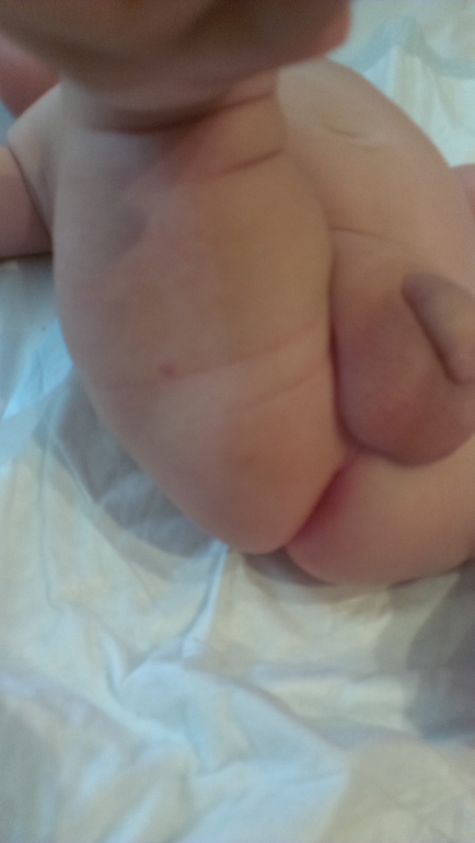 Потемнение на коже у грудничка