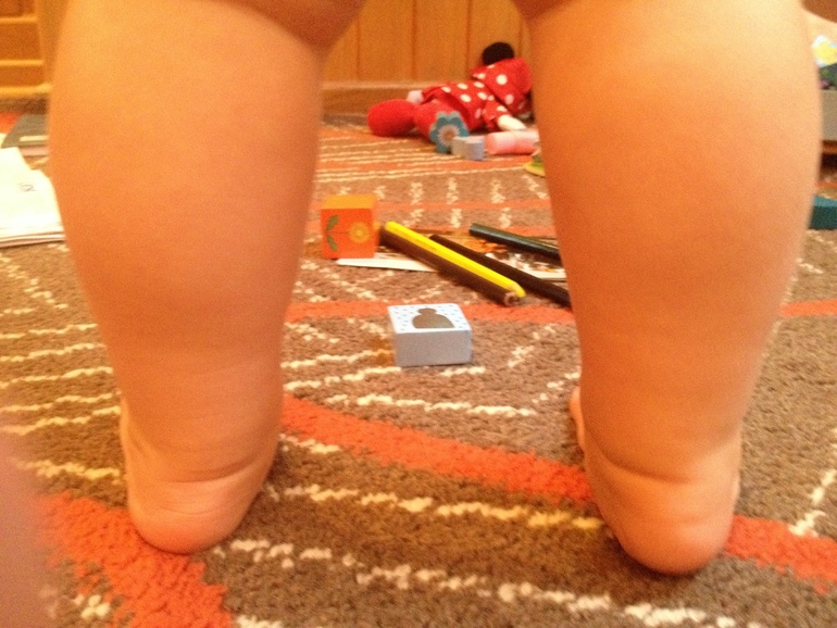 Посмотрите наши ножки на предмет плоско-вальгусной деформации, кто разбирается