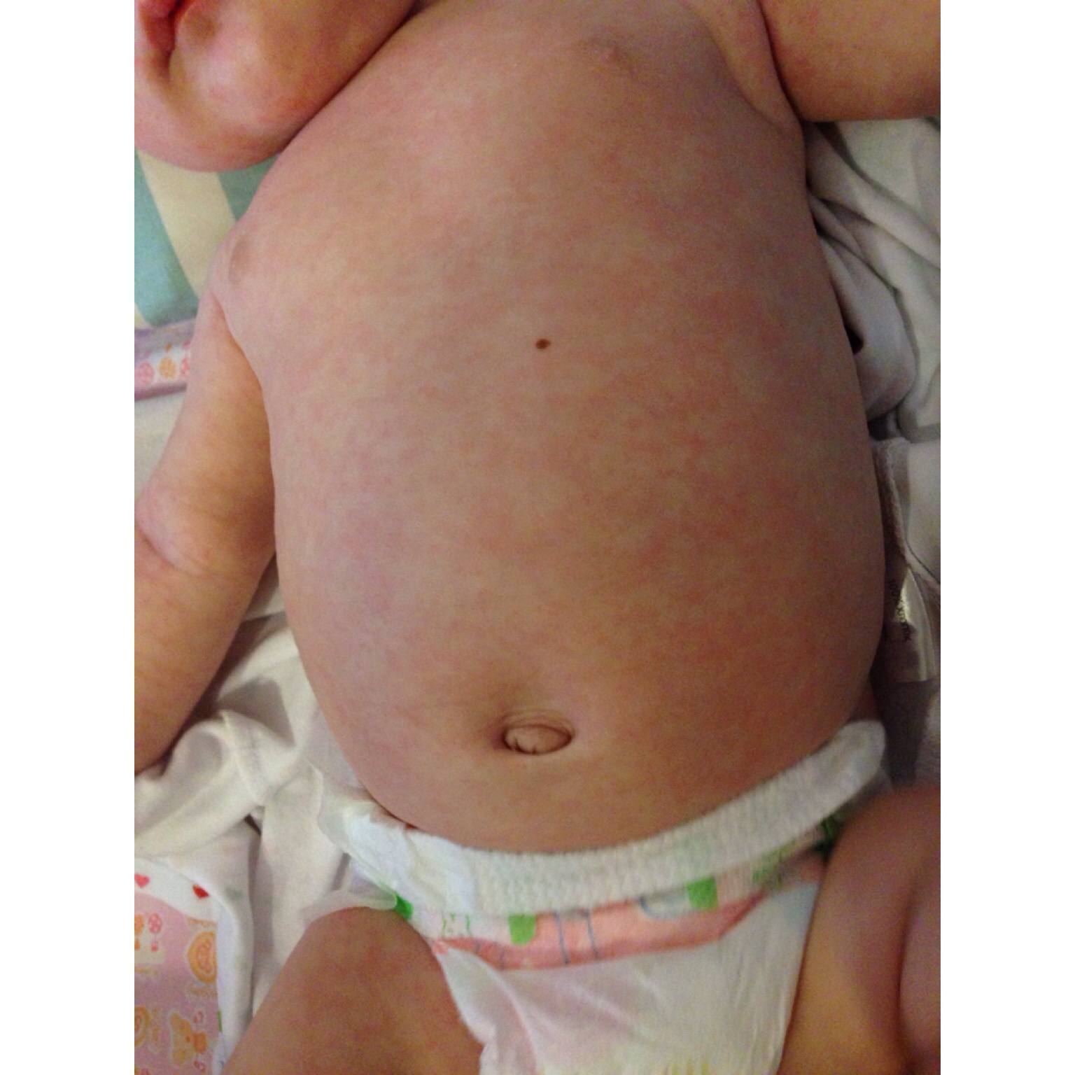 и снова сыпь....