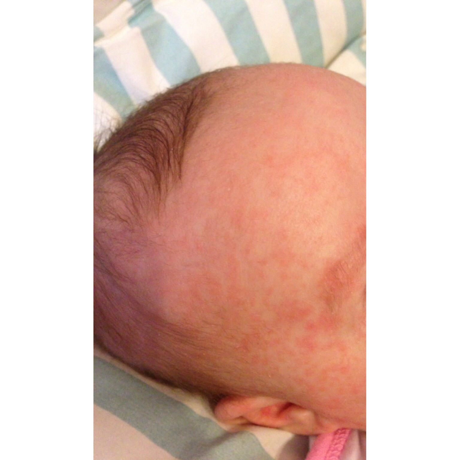 и снова сыпь....