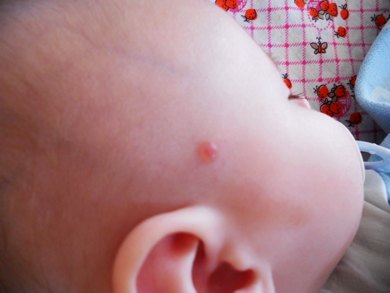 Прижгли гемангиому