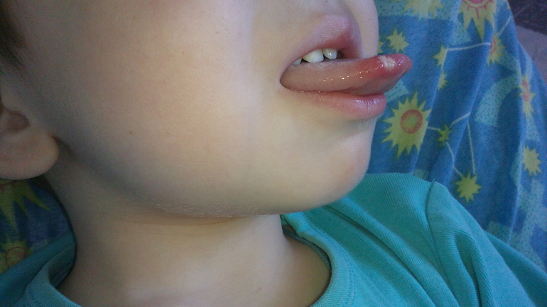 Ребенок не дает обработать рот при стоматите thumbnail