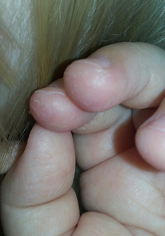 Шелушатся пальчики на руках