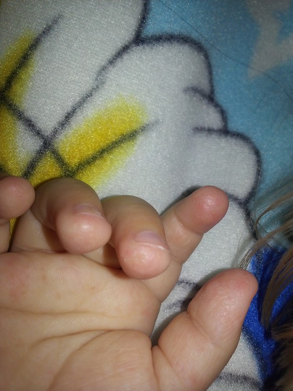 Шелушатся пальчики на руках