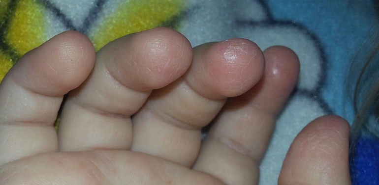 Шелушатся пальчики на руках