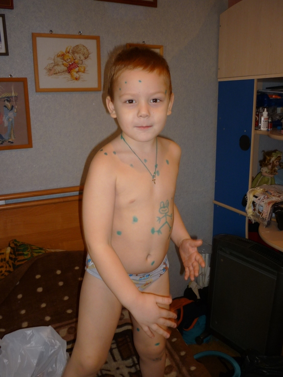 Ну вот, ветрянка и до нас добралась((