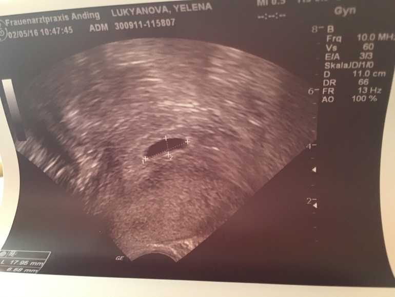 Беременность после первого эко. УЗИ после переноса эмбрионов. Первое УЗИ после криопереноса.