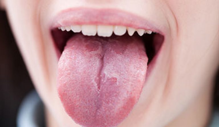 Пятно на языке. — 8 ответов | форум Babyblog